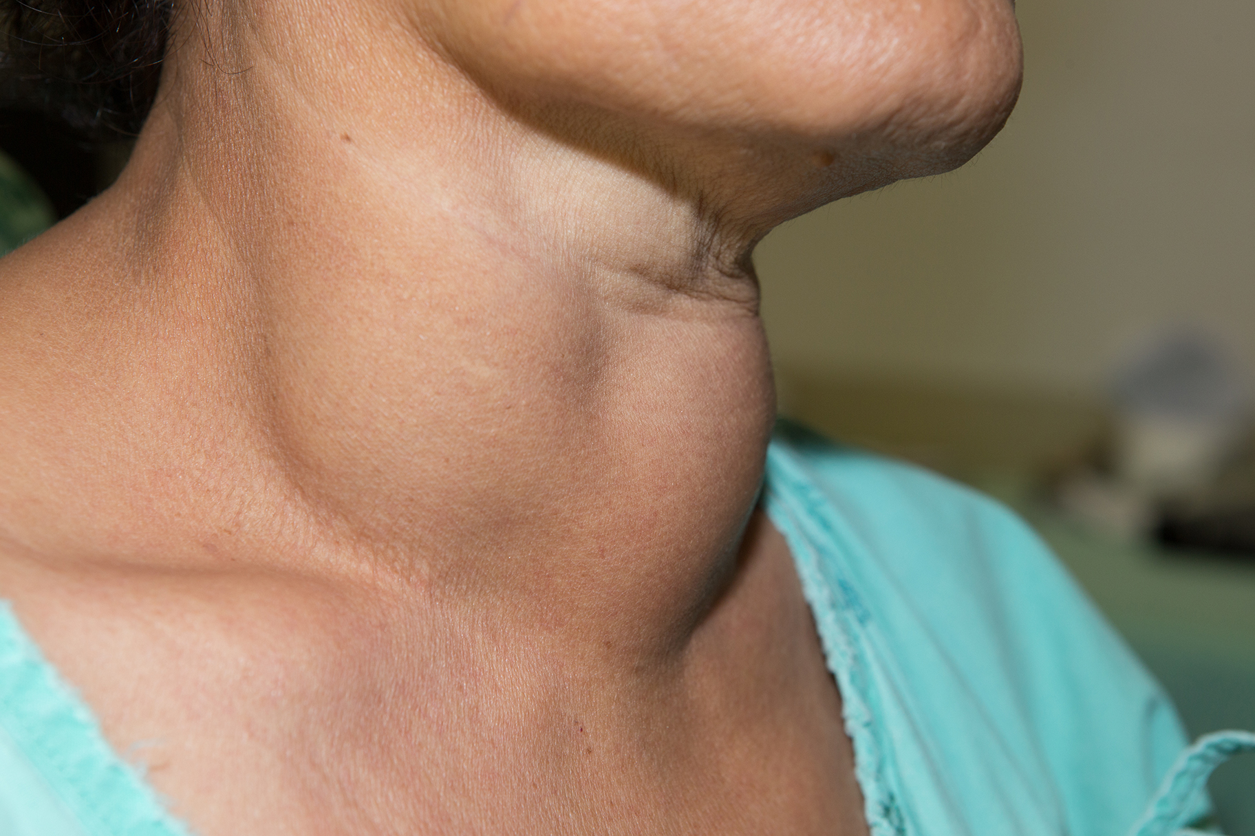Food Alert – Goitrogenic foods to limit in Hypothyroidism