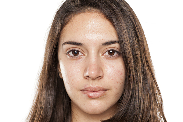 PCOS and Acne