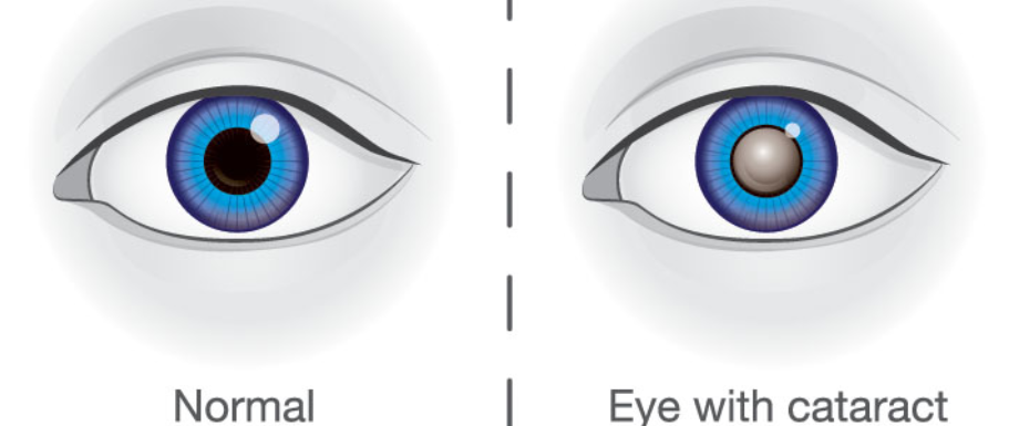 Diabetes and Eyes – Diabetic Cataract